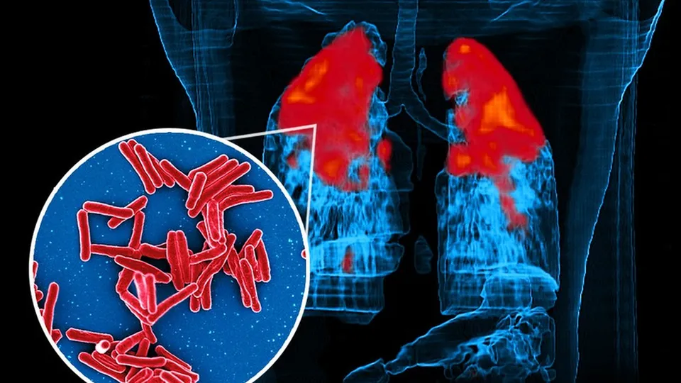 Dados alarmantes: 65,2% dos casos de tuberculose no Brasil são de negros