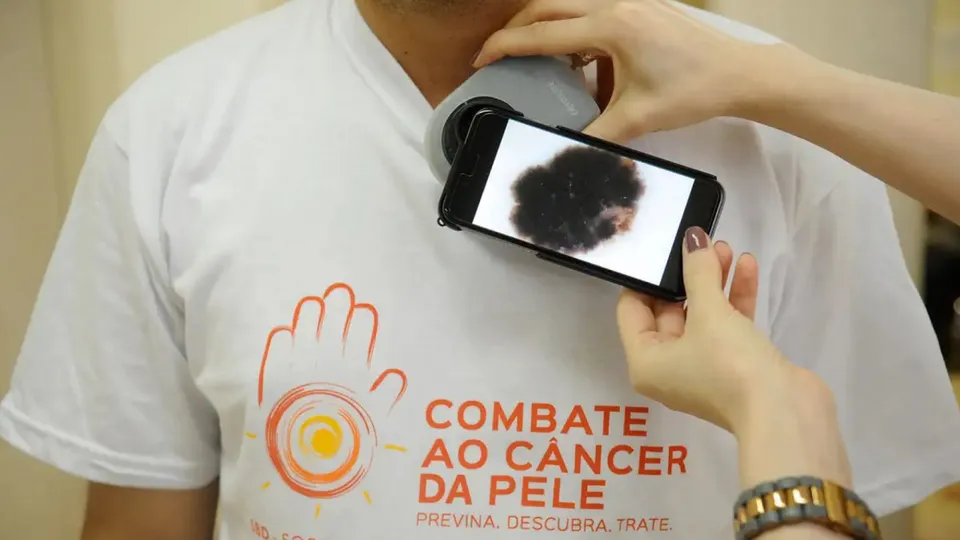 Neste sábado (7), mais de 2.000 dermatologistas estarão disponíveis para avaliação de lesões suspeitas em mais de 100 postos.