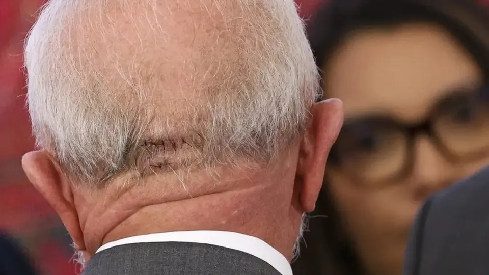 Presidente foi submetido a procedimento cirúrgico após queda em sua residência em outubro.