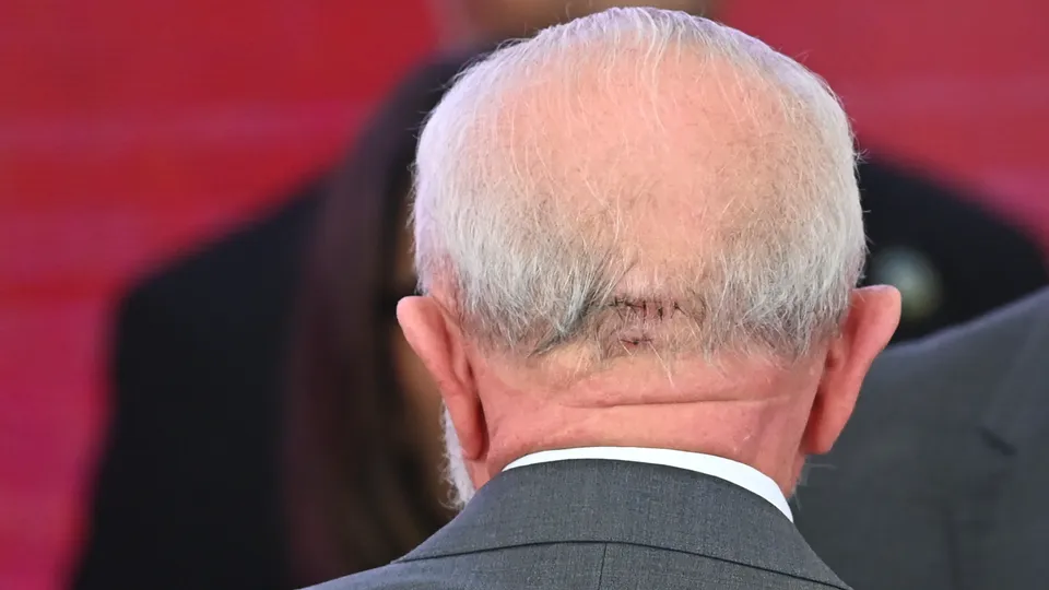 O presidente Luiz Inácio Lula da Silva terá um dreno na cabeça por até três dias para escoar secreção após cirurgia no cérebro, segundo médicos.