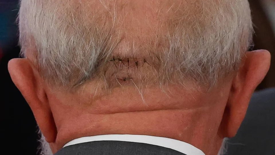 O presidente Luiz Inácio Lula da Silva será submetido a uma embolização para evitar novos sangramentos, após complicações recentes.