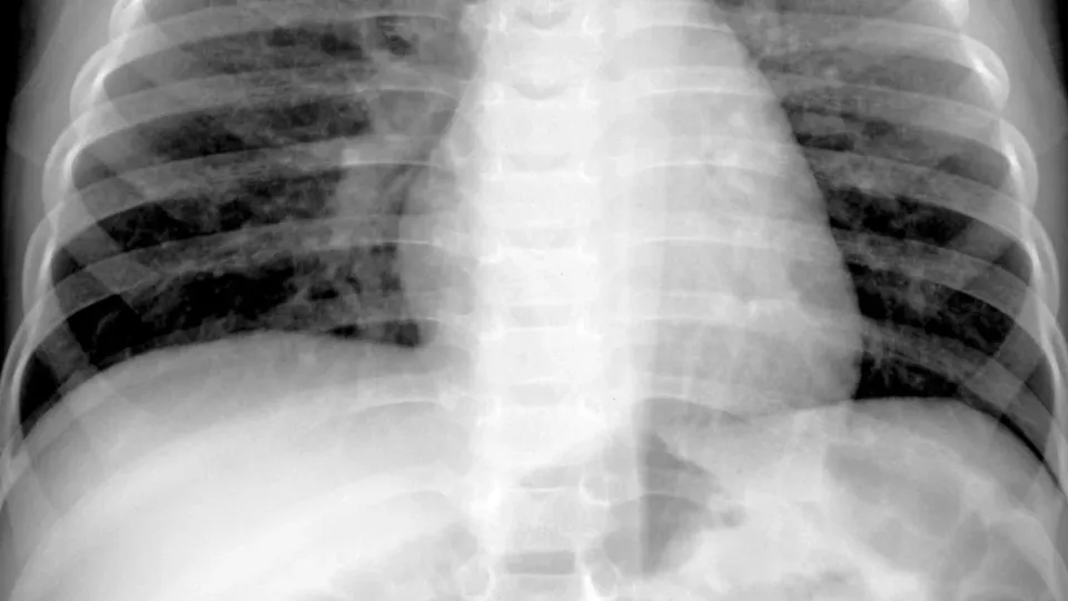 Metapneumovírus humano é um patógeno conhecido e não representa ameaça como a Covid-19, afirmam médicos