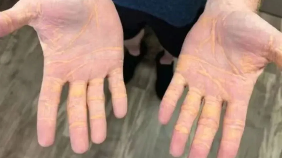 O paciente, que buscava emagrecimento, teve níveis de colesterol superiores a 1000 mg/dL, resultando em uma condição rara.